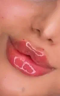 فیلربوتاکس ژل جراحی رفع غبغب پلک/مزوتراپی/توسطپزشک