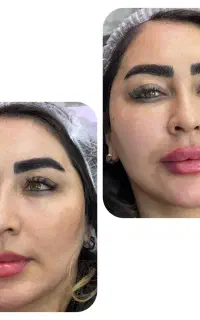 ژل و بوتاکس اصل ترمیم رایگان