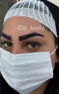 کاشت تخصصی مو و ابرو( میکرو کاشت)