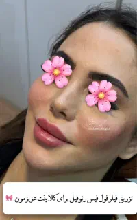آف آموزش و تزریق ژل بوتاکس پی آر پی