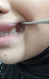 دندان اف ارسی