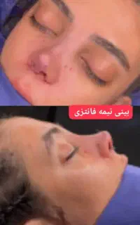 عمل بینی در تهران