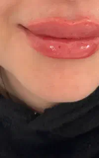 تزریق فیلر و کاشت ناخن