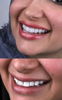 کامپوزیت دندان هالیودی بدون تراش با تخفیف واقعی