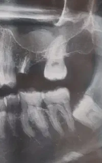 جراحی تخصصی دندان عقل و لثه با(تعرفه دولتی )
