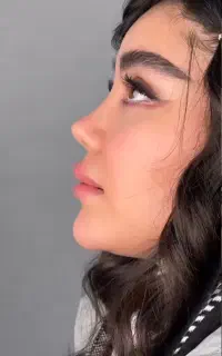 عمل بینی لیفت/لیپو ابدو/کاشت/دایرکت ابرو/رفع غبغب