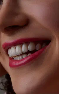 لمینت وکامپوزیت کن با کمترین پیش پرداخت