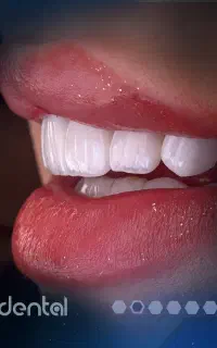 ایمپلنت لمینت کامپوزیت اقساط ویژه