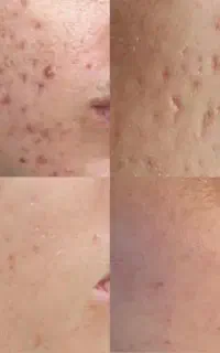 جدیدترین وقوی ترین تکنیک درمان مشکلات پوست