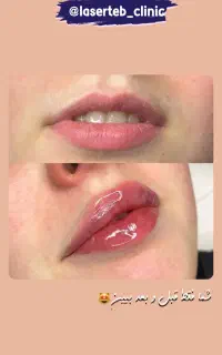 بوتاکس مصپورت تزریق فیلرلب،فیلرصورت مزوجوانسازو مو