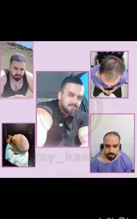 کاشت مو با ضمانت کتبی
