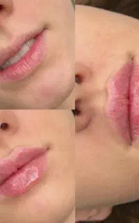 بوتاکس ژل لب خط خنده  پیرسینگ فیبروز خط چشم شید لب