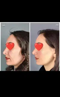 لیزر مو و رفع تیرگی مو وهایغو تراپی