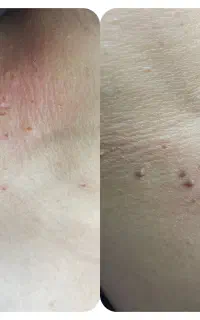 خال برداری،برداشتن منگوله،سوراخ کردن گوش