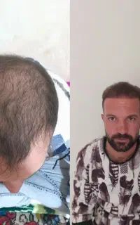 کاشت مو و ابرو به صورت تخصصی در تبریز و تمام قسط