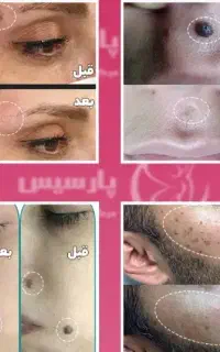 راهنمایی جهت از یین بردن خال و نشانه