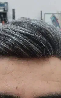 پروتز موی طبیعی