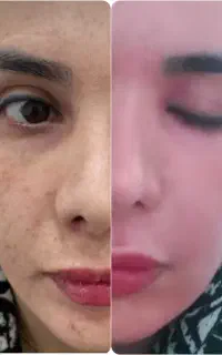 انجام لیزرco2و فرکشنال