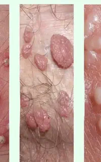 رفع قطعی و دائمی زگیل و‌تبخال