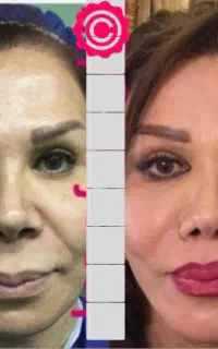 اعمال جراجی ثانویه(ترمیمی) پلاستیک - iranfacelift