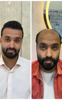 کاشت مو و ابرو در کلینیک تخصصی اقساطی