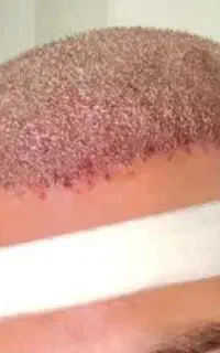 کاشت مو