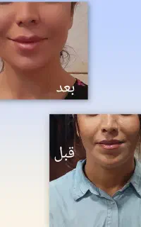 آموزش ژل وبوتاکس