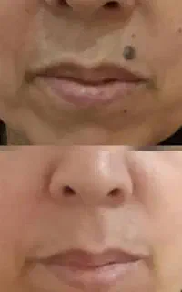 خال برداری تحت نظر پزشک