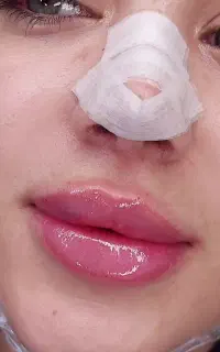 جشنواره تزریق فیلر لب،گونه،زاویه فک،چونه