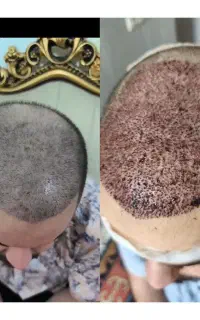 کاشت مو  ابرو ریش