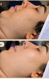 درماپلنینگ و اصلاح ابرو تخصصی