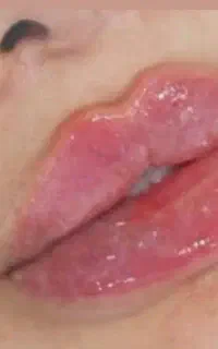 ژل و بوتاکس اقساطی