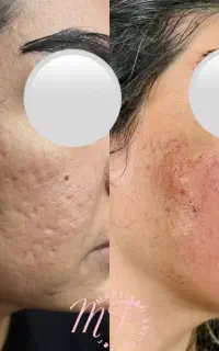 برداشت لک و فرو رفتگی صورت