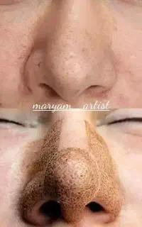 (کوچک کردن بینی فقط با1جلسه1200تومان) 50%تخفیف