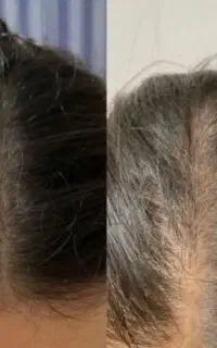 درمان تخصصی ریزش مو/بدون عوارض