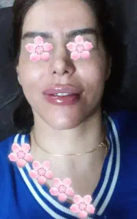 تخفیف ویژه ژل و بوتاکس