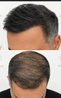 میکروپیگمنتیش مو