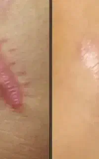 پاک کردن تاتو.جای زخم و ترک پوستی