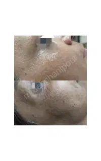 پلاسما خطوط پنجه کلاغی دور  چشم و لب چروک سطح پوست