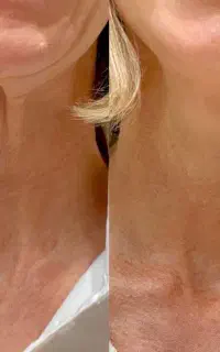 رفع چروک و خطوط گردن در کلینیک دکتر احیاکننده