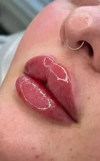 تخفیف ویژه خدمات و آموزش ژل بوتاکس