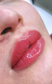 ریموو حرفه ای تتو با مواد بایوتیک