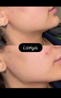 تززیق ژل و بوتاکس با جدیدترین متریال