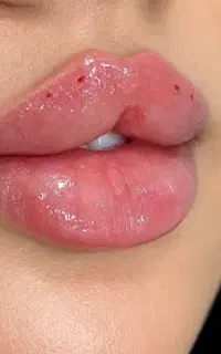 ژل و بوتاکس 50 درصد تخفیف
