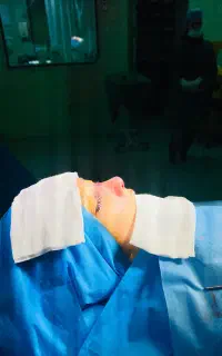 جراحی بینی باربی بدون تامپون در رشت (عمل بینی)