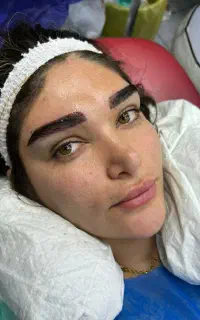کاشت مو میکرو کاشت ابرو