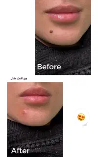 جشنواره ویژه،برداشتن تخصصی انواع خال،زگیل و میخچه