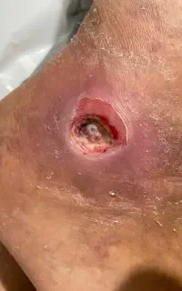 کارشناس زخم