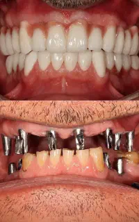 ایمپلنت کره آلمانی در مرکز تخصصی