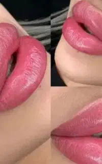 ژل و بوتاکس ،انزیم ،مزوتراپی شیدینگ لب